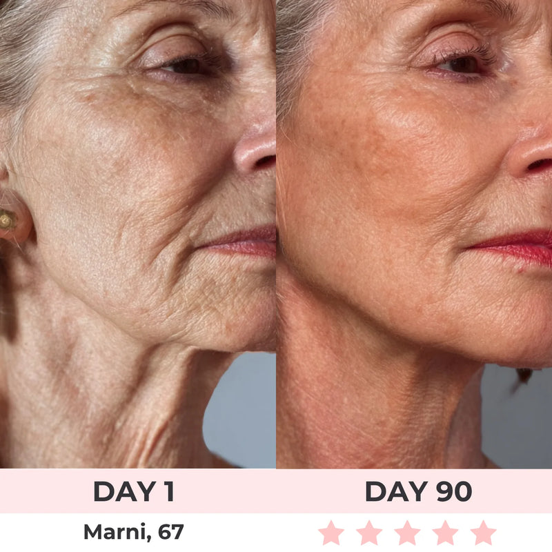 <p>''After 90 days, the sagging around my jawline has noticeably tightened, and my face looks more lifted and defined. I'm beyond thrilled with the results, it's like turning back the clock!''</p>